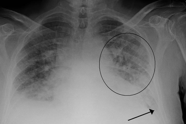 MIT scientists have developed a new machine learning tool that assesses fluid buildup in the lungs