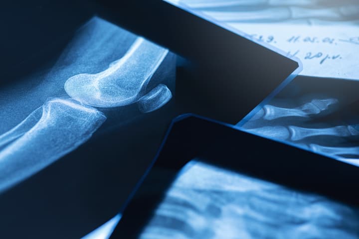 Bioactive glass laced with toxic metal shows promise in treating bone cancer